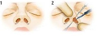  p>鼻翼缩小术是一种缩小鼻翼的手术. /p>