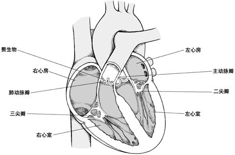 非感染性心内膜炎