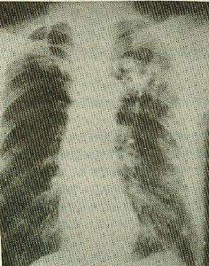 慢性阻塞性肺炎(obstructive pulmonary emphysema)又称阻塞性肺气肿