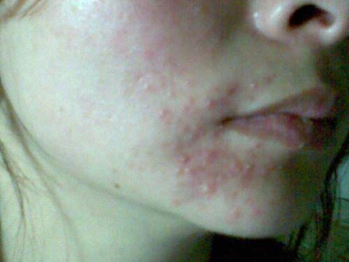 过敏型痘痘丘疹