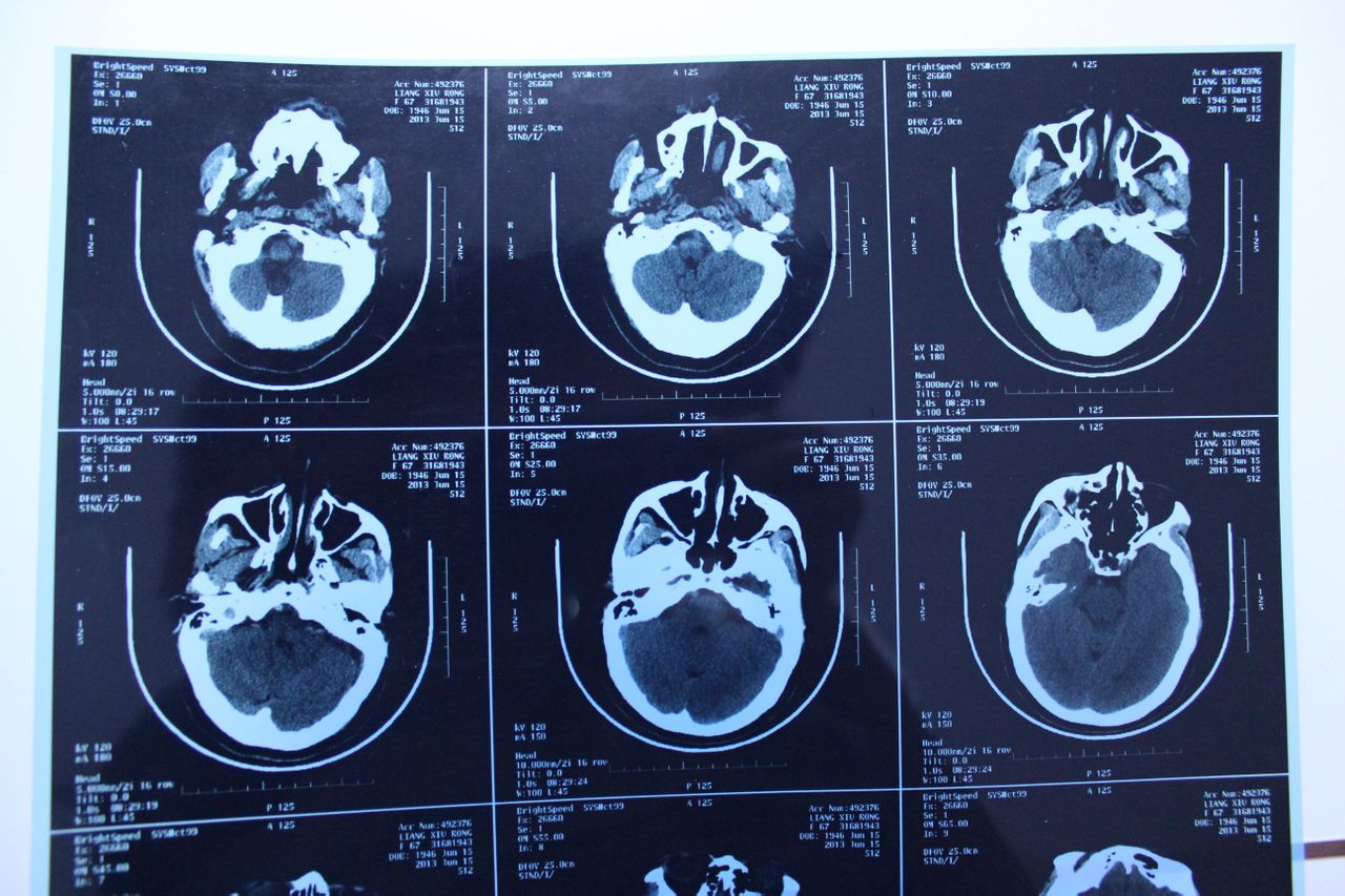 多腔隙性脑梗塞