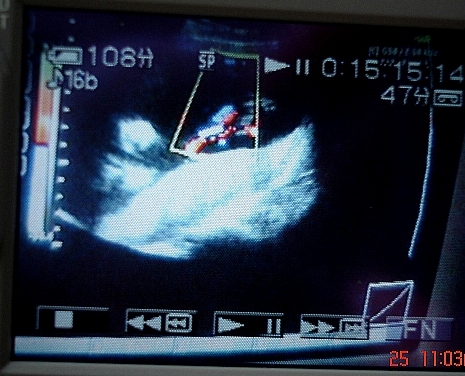  p>脐血流是指脐动脉收缩期最高血流速度与舒展期最低血流速度的比值