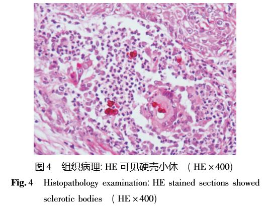  p>内基氏小体(negri bodies)狂犬病毒形成的包涵体,呈圆形或椭圆形