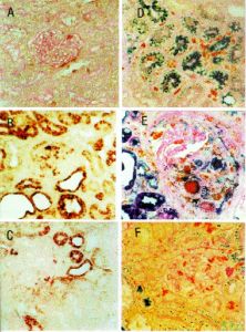 新月体肾炎