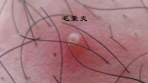 感染,炎症融合形成的叫 a target="_blank" href="/item/痈/508306"