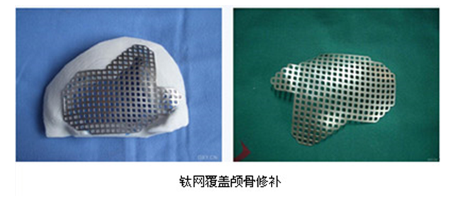 人工颅骨材料要有硅胶,钛合金,聚丙烯聚脂高分子材料及自身骨头等等.