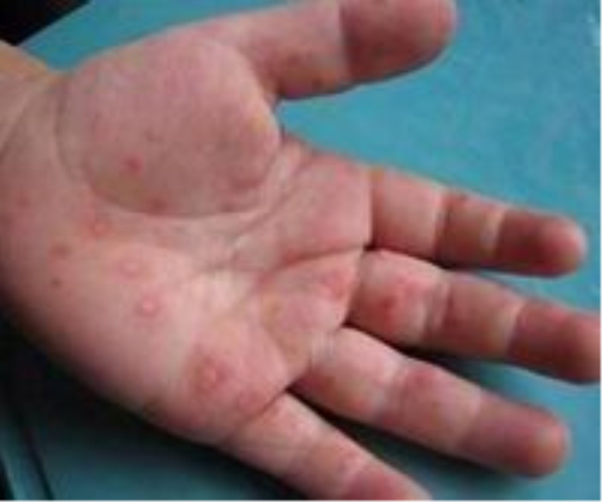 ">疱疹病毒 /a>引起的 a target="_blank" href="/item/传染病