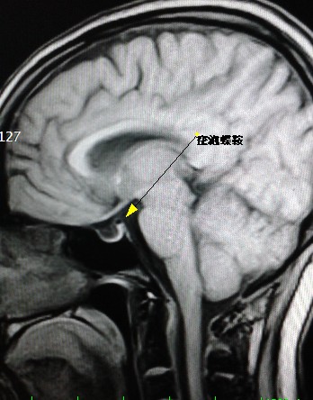 空泡蝶鞍综合征 emptysellasyndrome 系因鞍隔缺损或垂体萎缩,蛛网膜