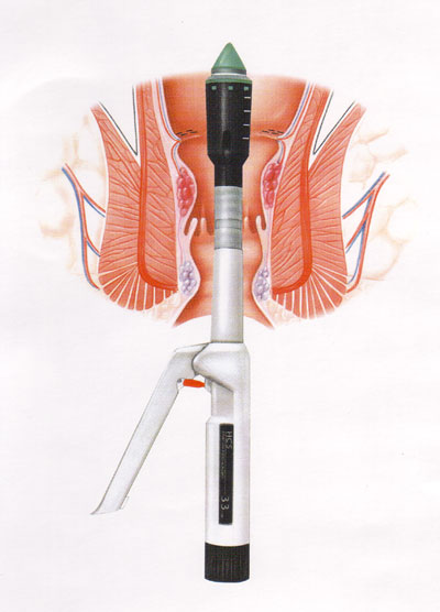 改良whitehead内痔环切术