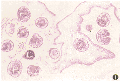 细粒棘球绦虫病