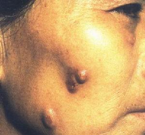  p>皮肤型孢子丝菌病是由 a target="_blank" href="/item/申克氏孢子