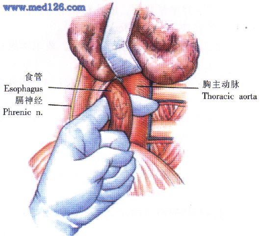 胸下段癌可放宽至Ⅲ期;较局限的贲门癌,全身情况良好,无手术禁忌者
