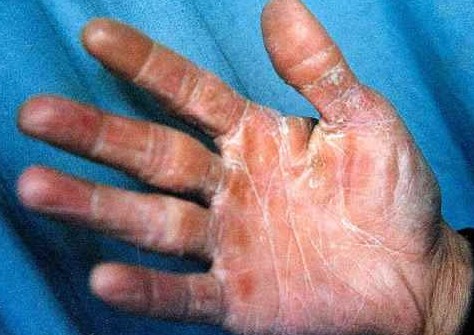  p>角化型手癣真菌性皮肤疾病发病比较严重的情况下往往会累及双手