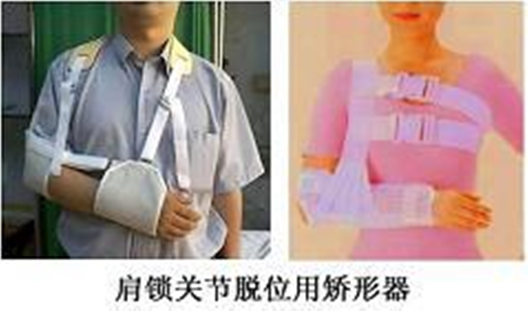 肩锁关节脱位用矫形器