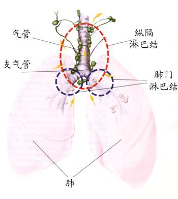原发性支气管肺癌