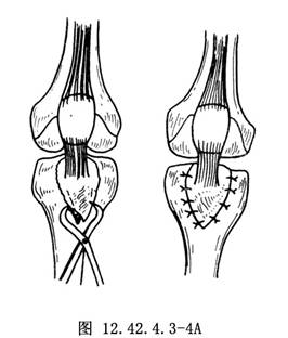 gn4yzyalef">胫骨结节撕脱骨折切开复位术用于胫骨上端骨折的手术治疗