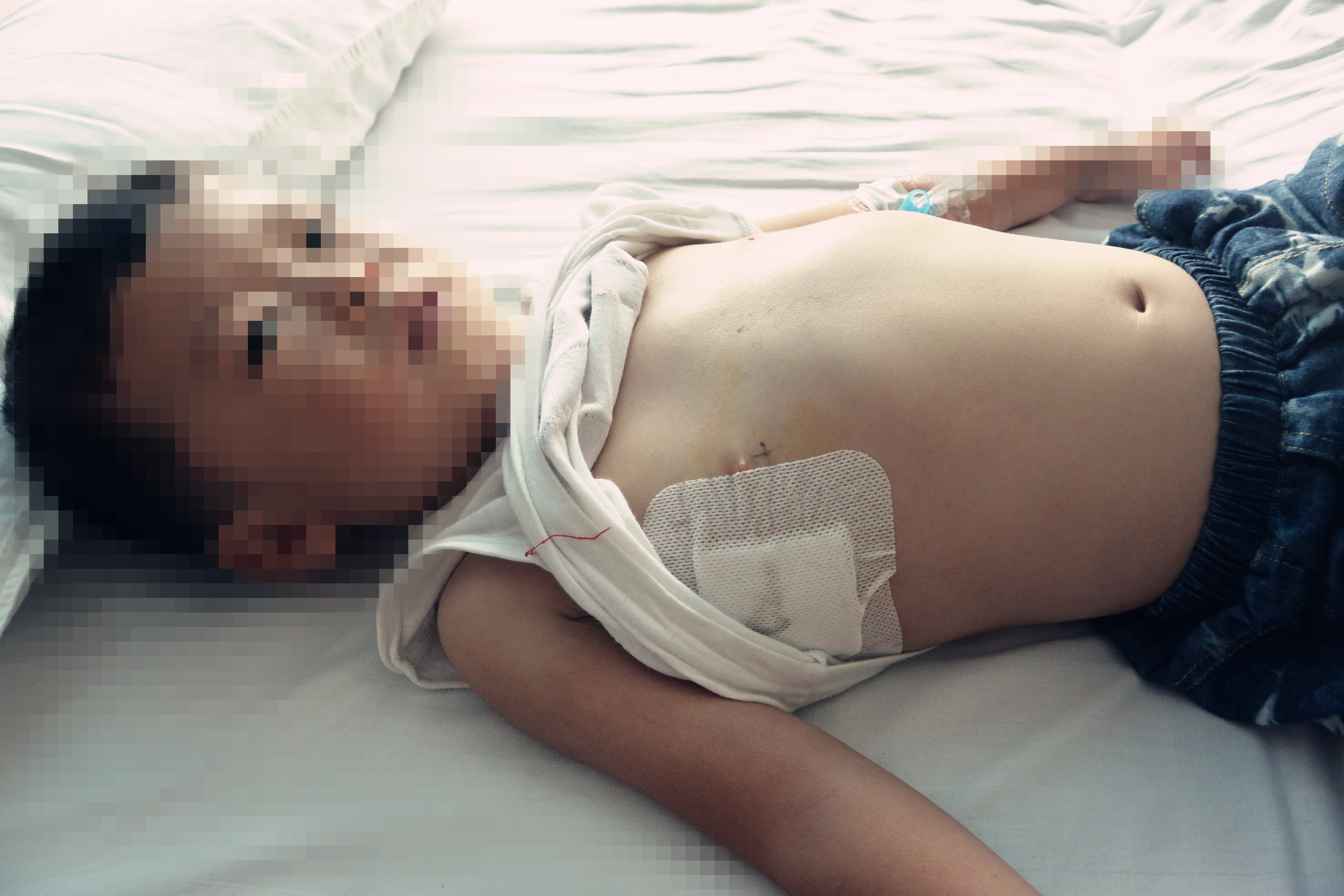 畸形轻而无症状者可不予手术,观察为主,12岁以下的孩子都可以做单孔