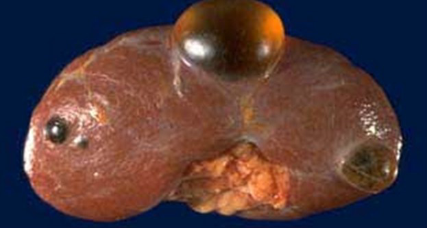  p>在肾囊肿,多囊肾的治疗上,还是多以临床治疗结合穿刺为主,但这只是