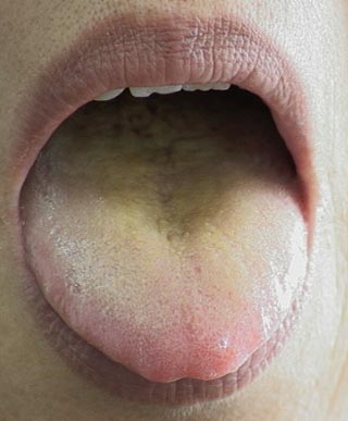  p>舌苔黄腻在 a target="_blank" href="/item/中医诊断/2228561"