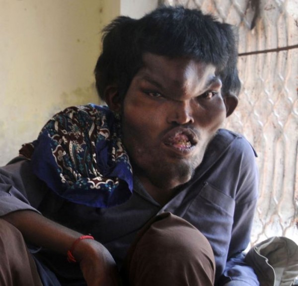 普罗特斯综合症