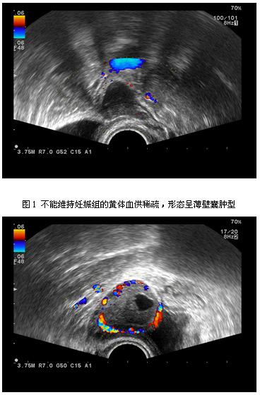 corpus luteum of pregnancy
