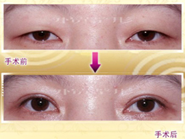  p>眼外眦开大术是想要眼睛显得大时切开眼睛外眼角部位,延长水平长度