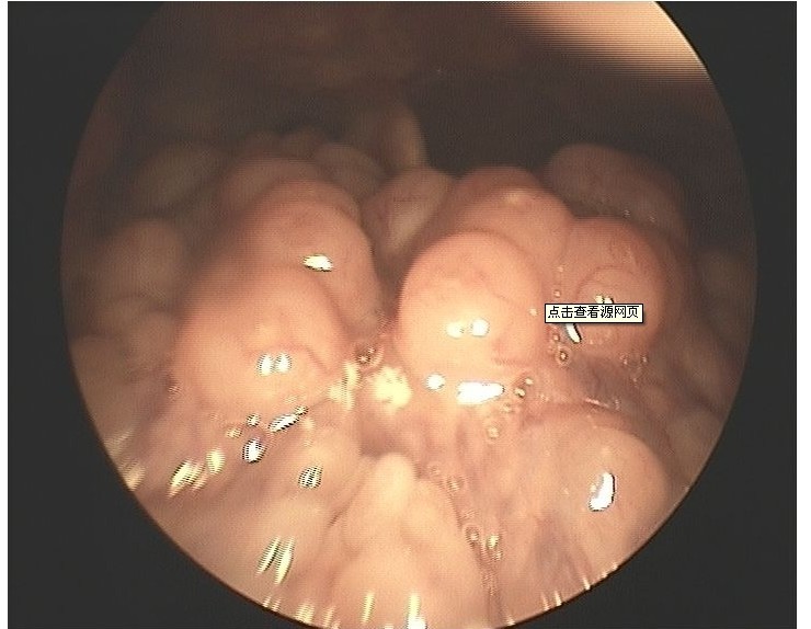 舌根淋巴滤泡增生
