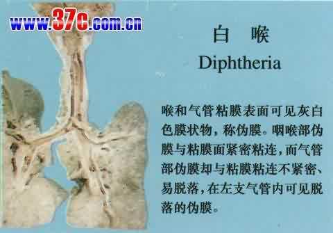  p data-id="gnb3aoh6yg">白喉是白喉杆菌引起的急性呼吸道传染病.