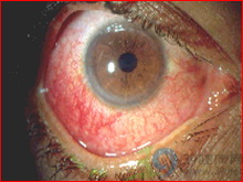 急性前葡萄膜炎