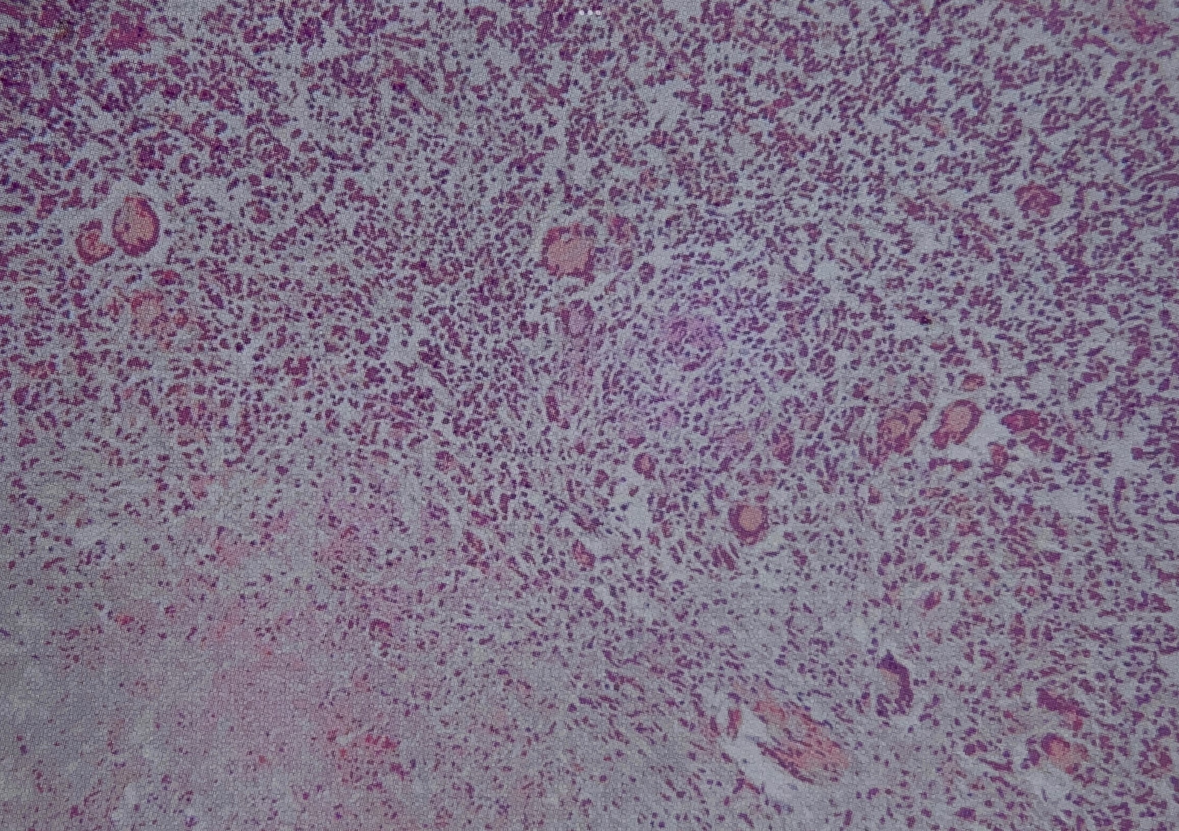  p>结核结节(tubercle):是在细胞免疫的基础上形成的,由 a target="