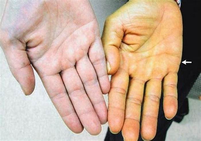  p>dubin-johnson综合征是一种先天性疾病,有较明显的家族背景,为常