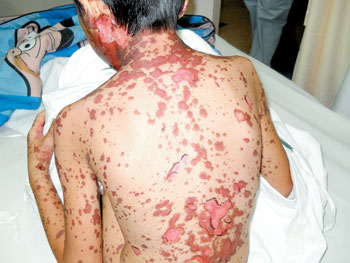 steven johnson 综合症