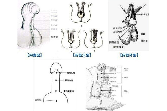 data-lemmaid="1767216">阴茎弯曲 /a>,尿道开口不在 a target="