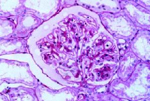双肾狼疮性肾病
