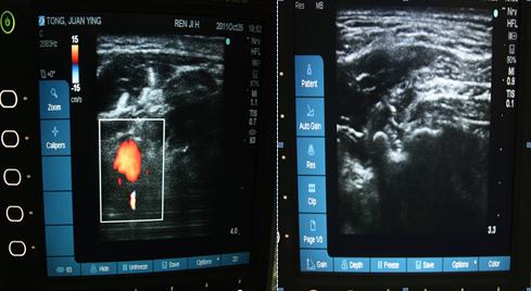 肌筋膜炎又称"腰背肌损伤","腰背部纤维炎","腰背筋膜疼痛症候群"等