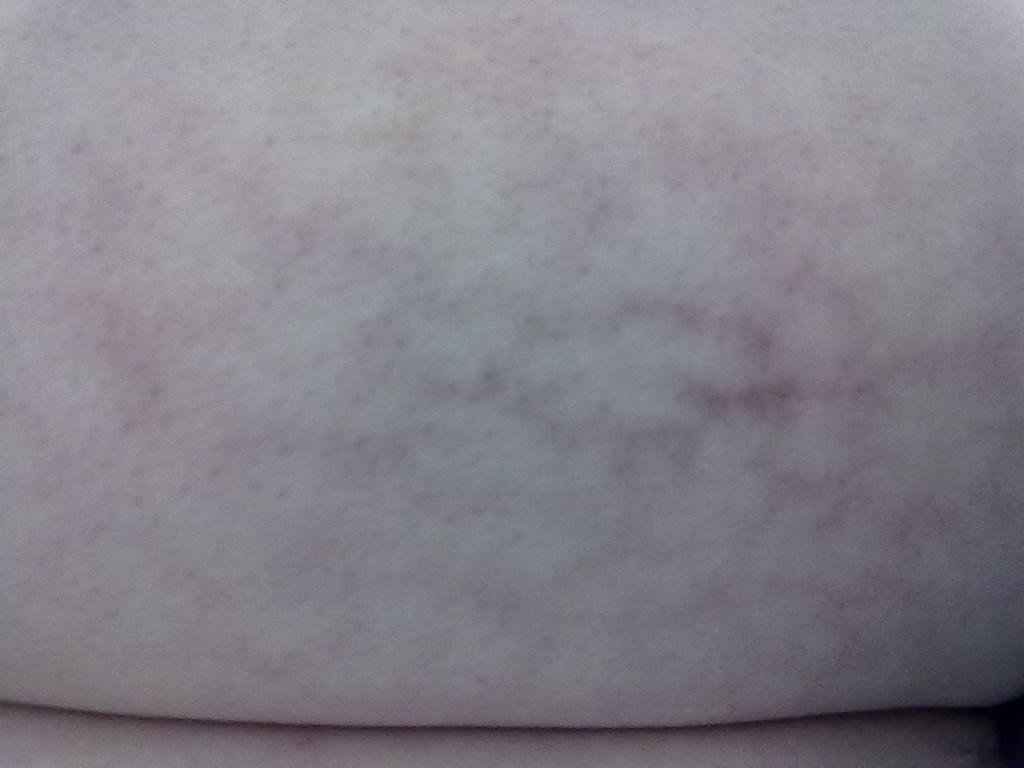 热激红斑是皮肤长期,反复暴露于红外线后