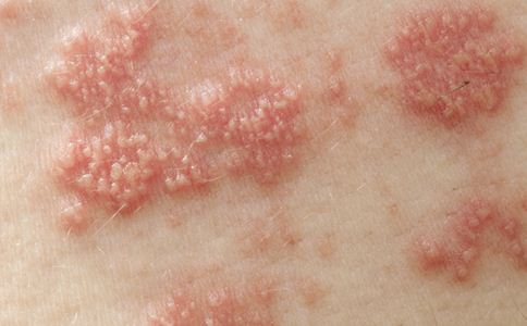 疣状增殖,疣状指一种皮肤表面赘生物的形状,多表现为突起状,因形似疣