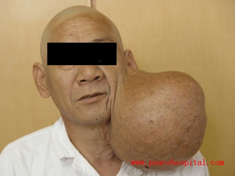  p>恶性多形性腺瘤(malignant mixed tumor)从临床和病理的不同表现