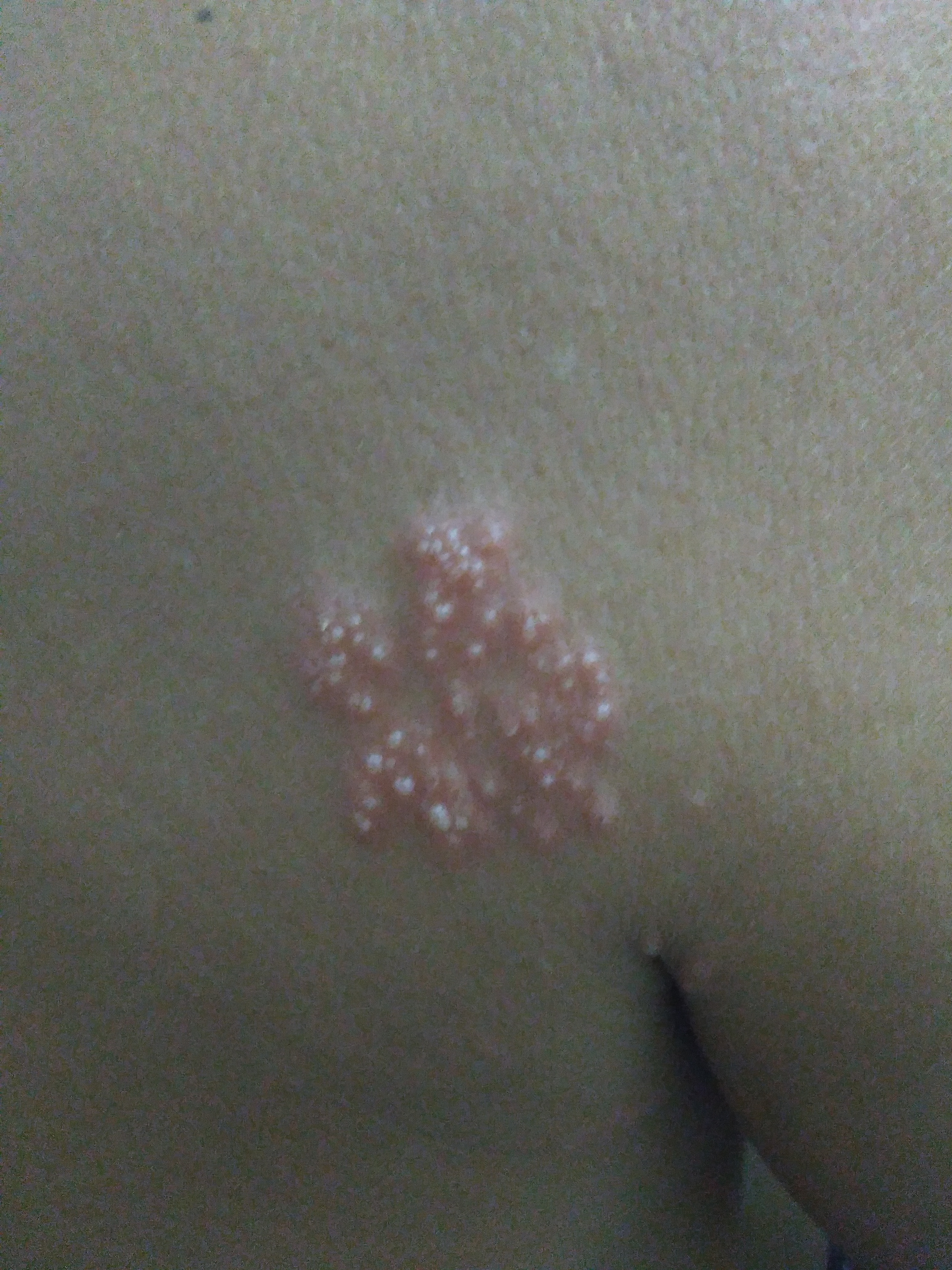  p>水痘-带状疱疹病毒(varicella-zoster virus,vzv)是指在儿童初次