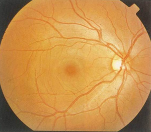 是指在挫伤后,后极部出现的一过性视网膜水肿,视网膜变白,视力下降.