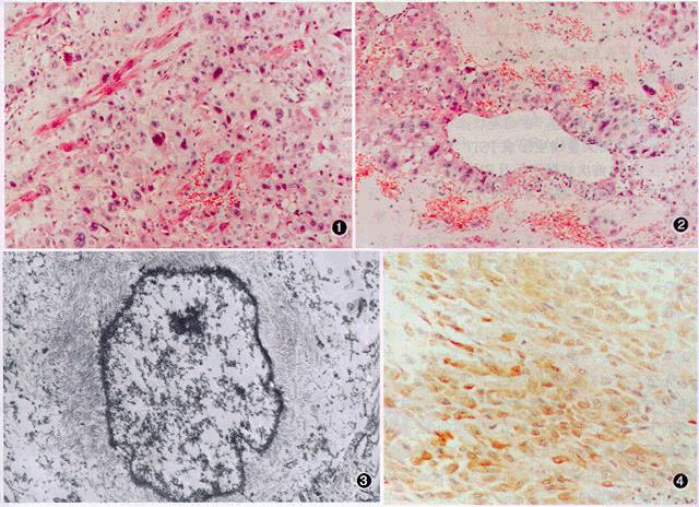 胎盘部位滋养细胞肿瘤
