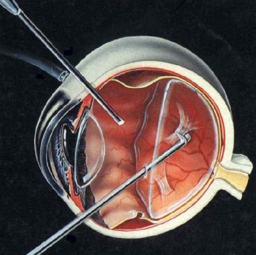  p>正常 a target="_blank" href="/item/玻璃体/3804762" data-lemma