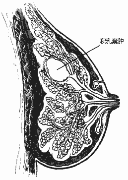  p>乳腺肿块是乳房疾病的常见体征.