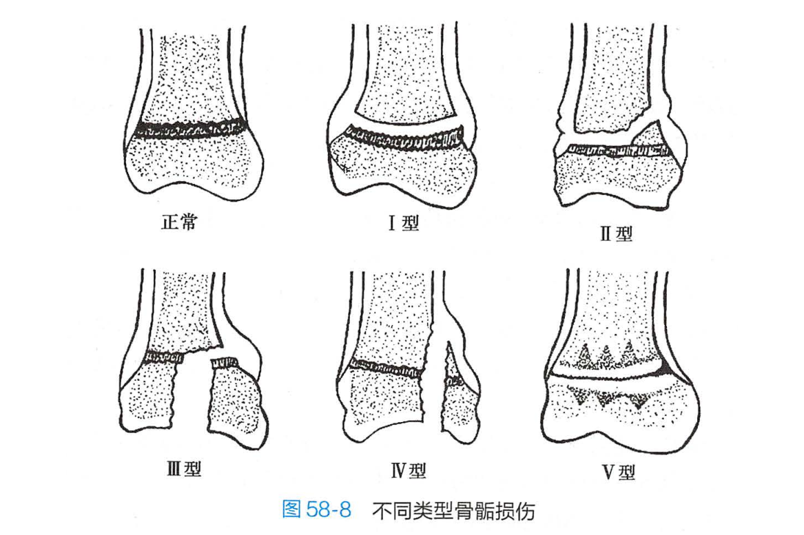 骨骺损伤