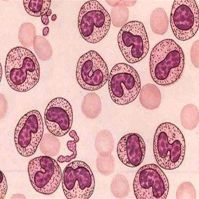 巨大血小板综合征