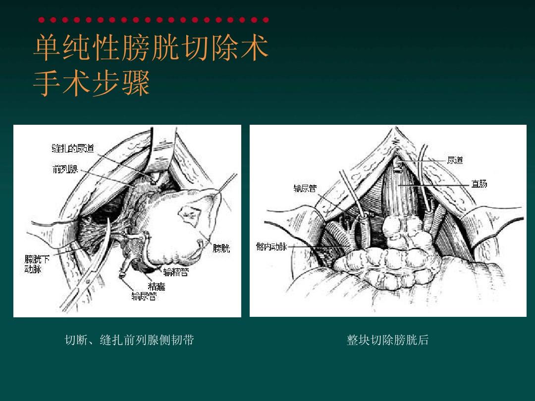  p>全膀胱切除术在男性是将 a href="#" data-lemmaid="757577">膀胱 