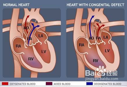 完全性大动脉转位矫正手术