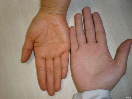 泛黄,家长以为孩子得了 a href="#" data-lemmaid="652091">黄疸肝炎