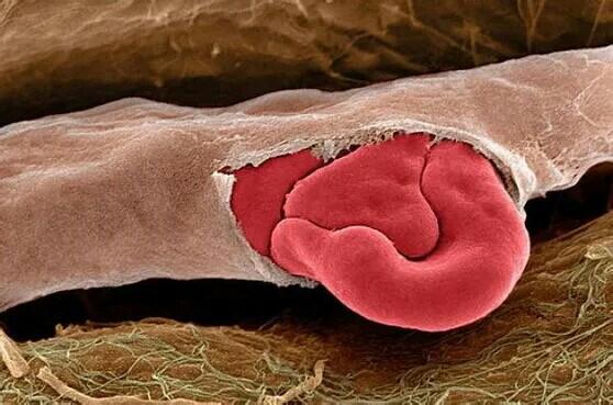  p>毛细血管破裂是一种发生在面部或躯干部位的 a href="#" data