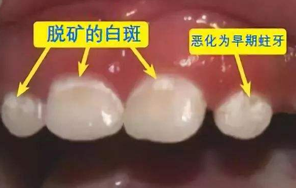 p>脱矿,也叫脱钙,指人的牙齿牙釉质表面的钙磷脱落,因而使牙齿色泽
